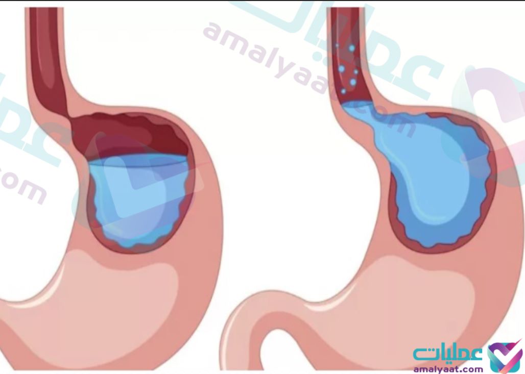 اعراض ارتجاع المريء الصامت